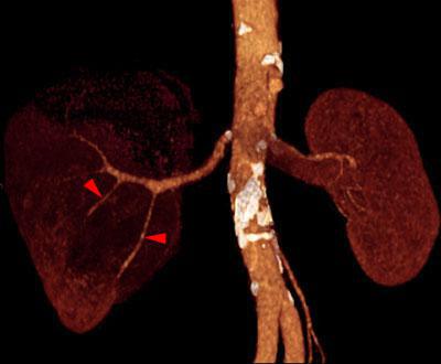 Tumor renal necrosado