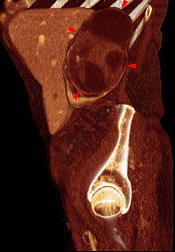 Tumor renal necrosado