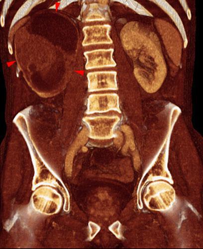 Tumor renal necrosado