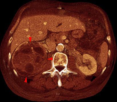 Tumor renal necrosado
