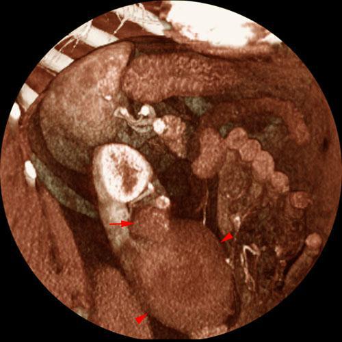 Tumor renal. Invasión de vía urinaria