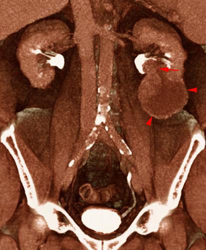 Tumor renal. Invasión de vía urinaria