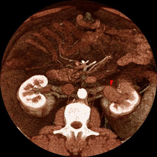 Tumor renal. Invasión de vía urinaria