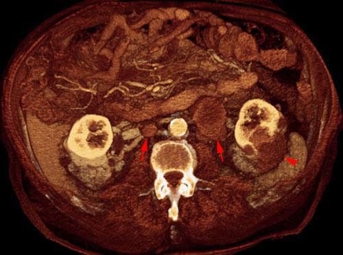 Hipernefroma. Adenopatías