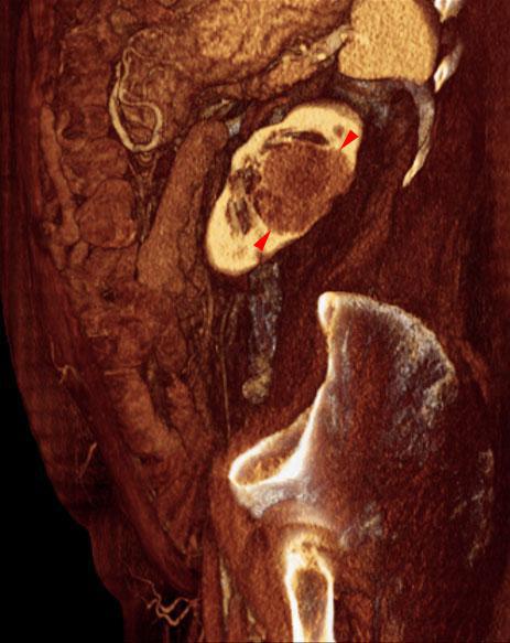 Hipernefroma. Adenopatías