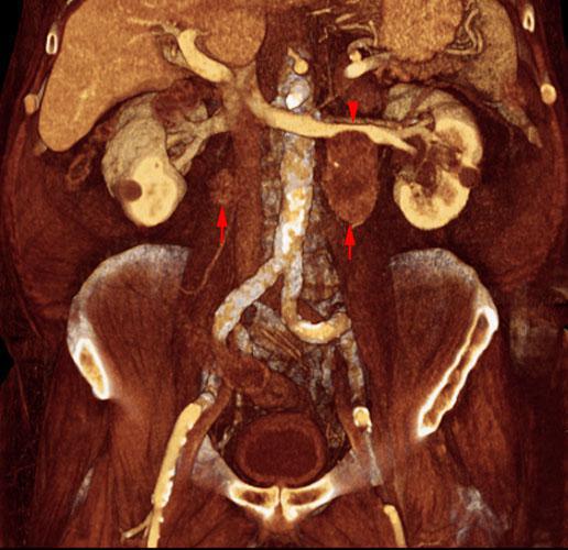 Hipernefroma. Adenopatías