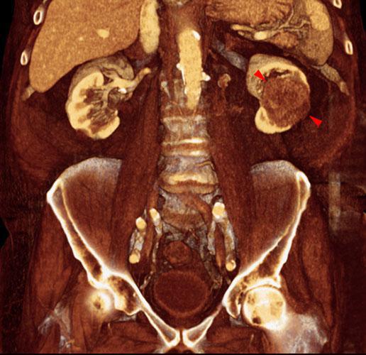 Hipernefroma. Adenopatías
