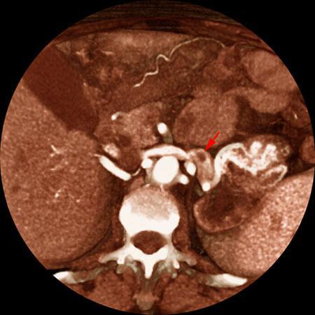 Tumor renal con trombosis venosa
