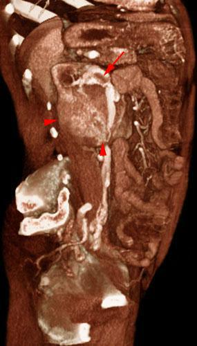 Tumor renal con trombosis venosa