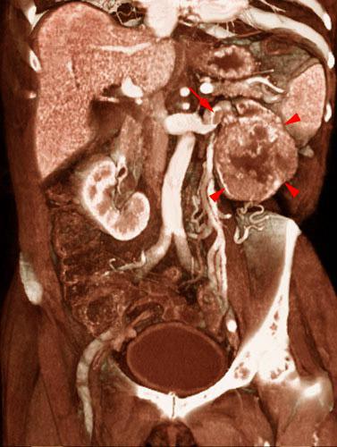 Tumor renal con trombosis venosa