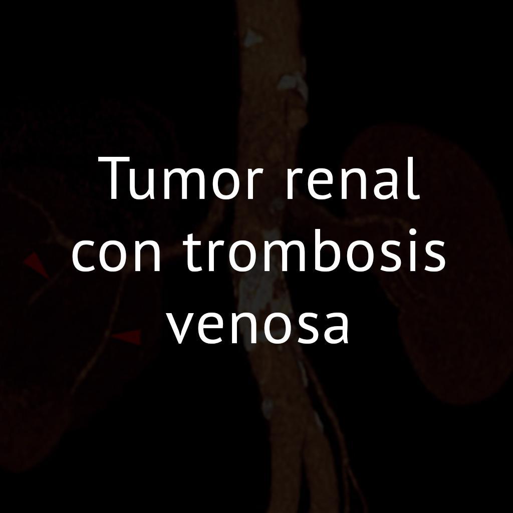Tumor renal con trombosis venosa