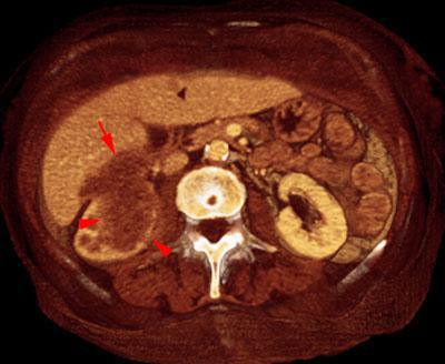 Metástasis renal de carcinoma broncopulmonar