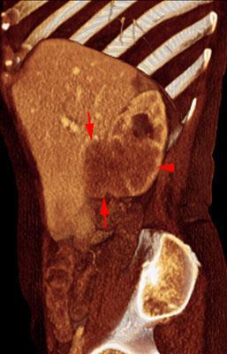 Metástasis renal de carcinoma broncopulmonar