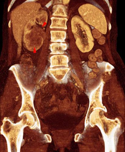 Metástasis renal de carcinoma broncopulmonar