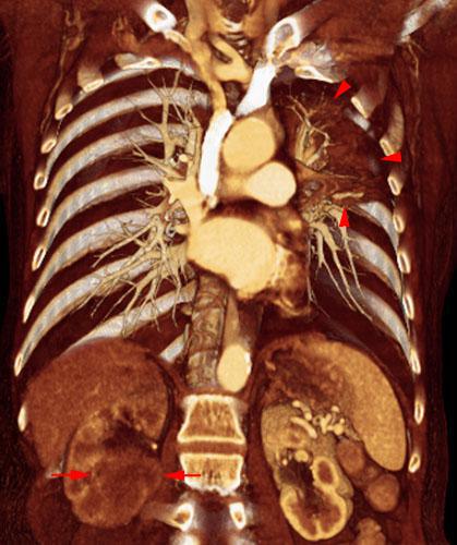 Metástasis renal de carcinoma broncopulmonar