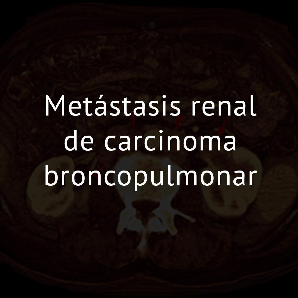 Metástasis renal de carcinoma broncopulmonar