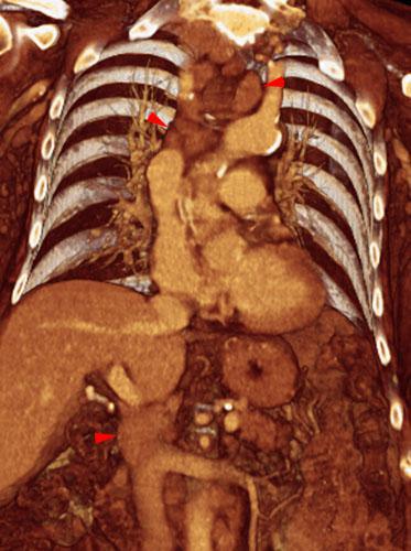 Linfoma renal secundario