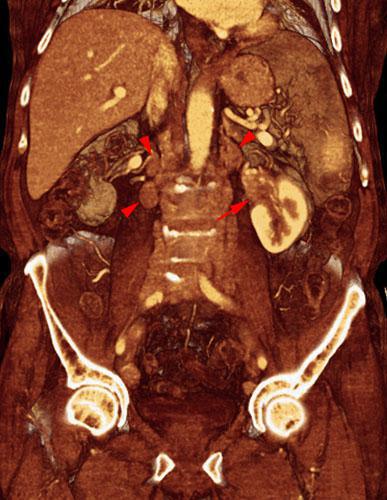 Linfoma renal secundario