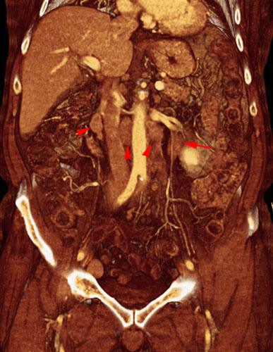 Linfoma renal secundario