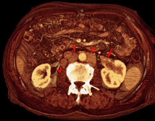 Linfoma renal secundario