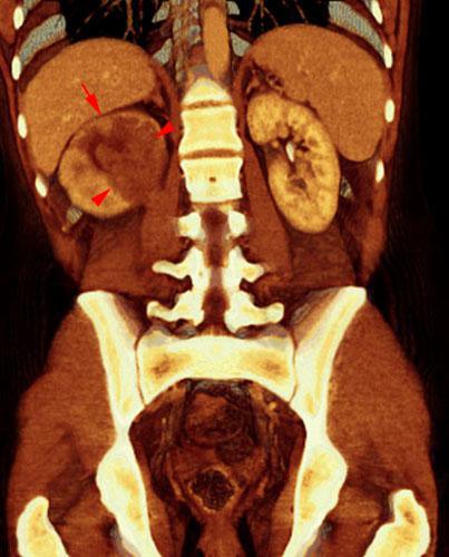 Carcinoma medular renal