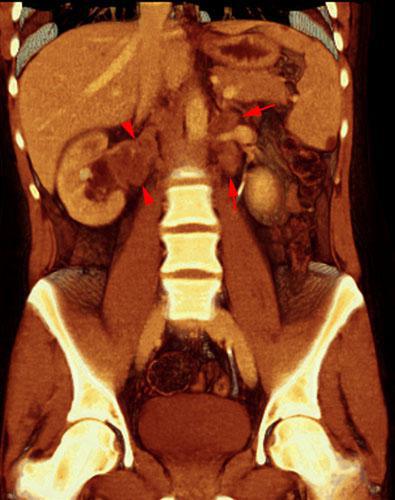 Carcinoma medular renal