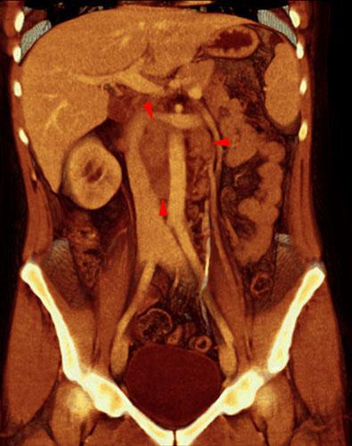 Carcinoma medular renal