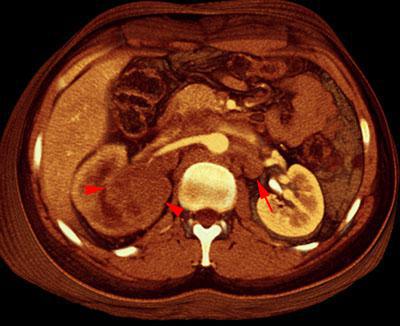 Carcinoma medular renal