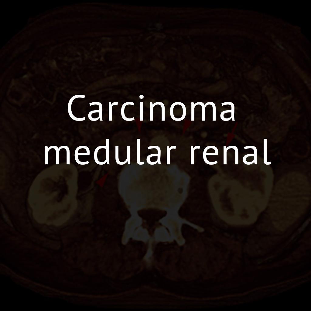 Carcinoma medular renal