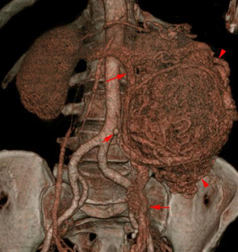 Hipernefroma muy vascularizado