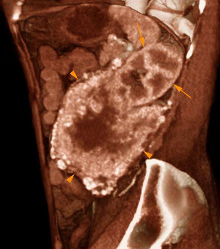Hipernefroma muy vascularizado