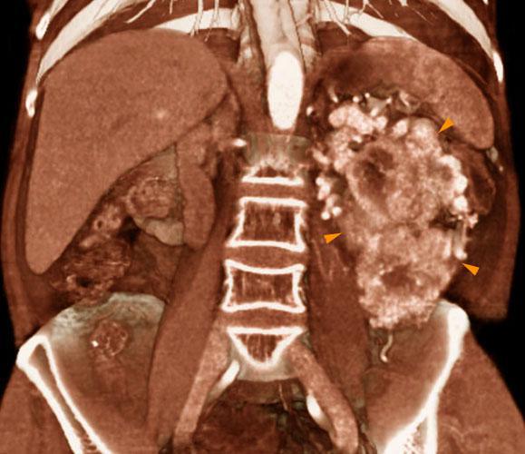 Hipernefroma muy vascularizado