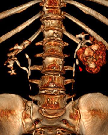 Obstrucción renal en duplicidad. Absceso renal