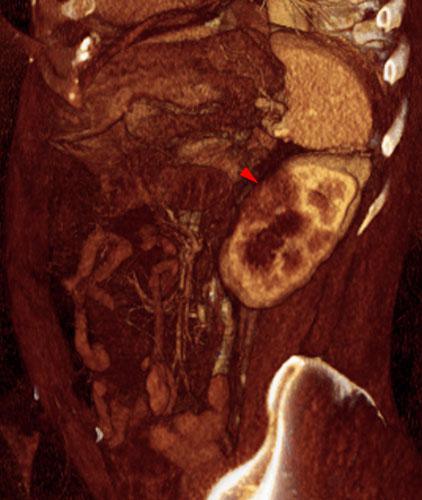 Obstrucción renal en duplicidad. Absceso renal