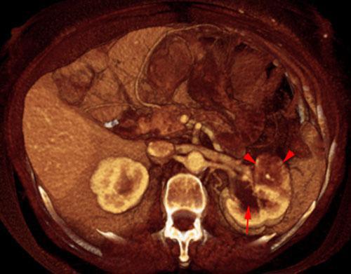 Obstrucción renal en duplicidad. Absceso renal