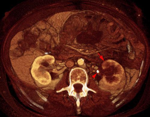 Obstrucción renal en duplicidad. Absceso renal
