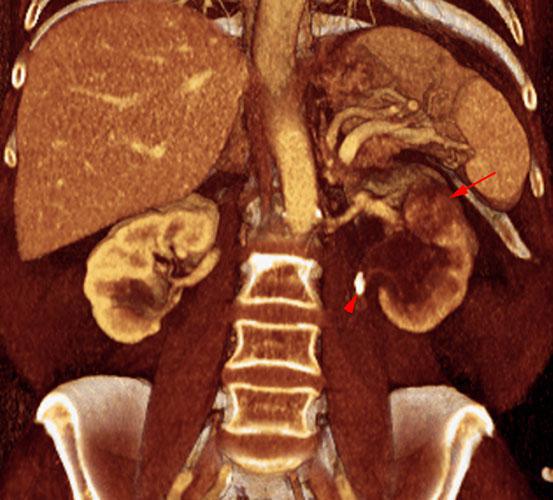 Obstrucción renal en duplicidad. Absceso renal