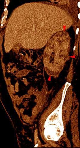 Abscesos renales en pionefrosis