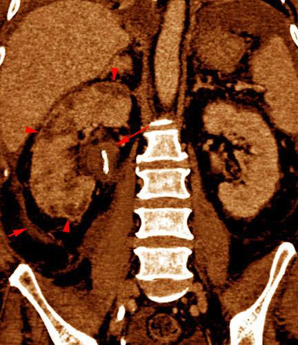 Abscesos renales en pionefrosis
