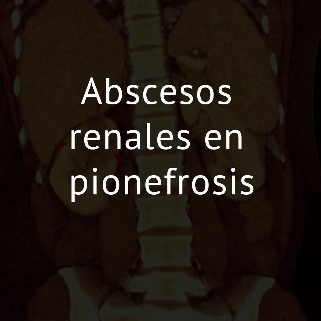 Abscesos renales en pionefrosis