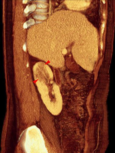 Pielonefritis aguda 2