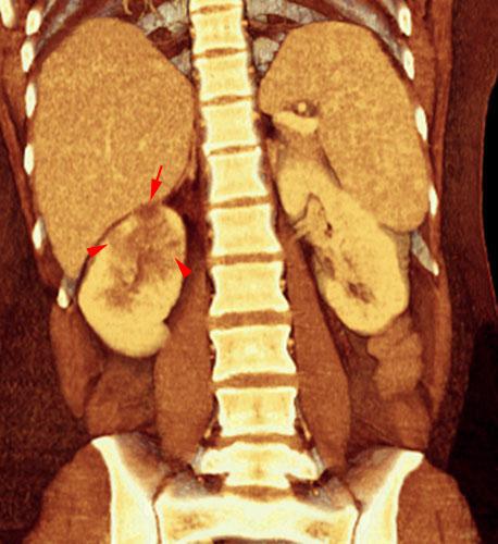 Pielonefritis aguda 2