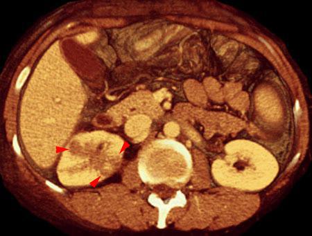 Pielonefritis aguda 2
