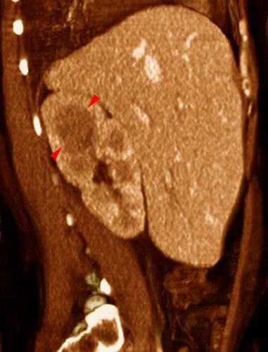 Pielonefritis aguda 1