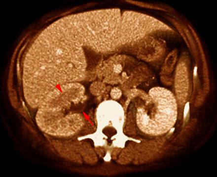 Pielonefritis aguda 1