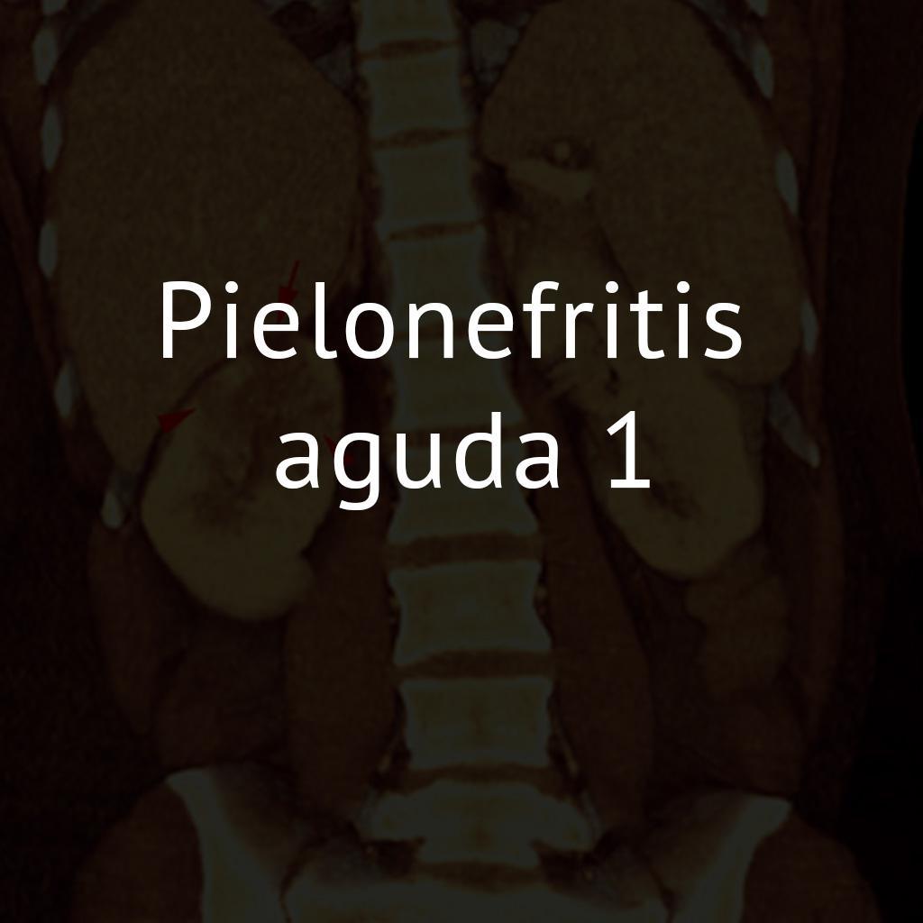 Pielonefritis aguda 1
