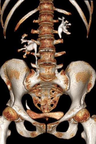 Pielonefritis bilateral aguda y crónica