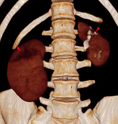 Pielonefritis bilateral aguda y crónica