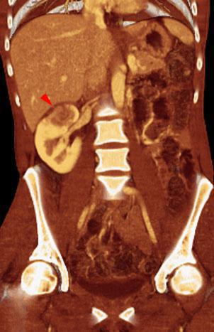 Pielonefritis bilateral aguda y crónica