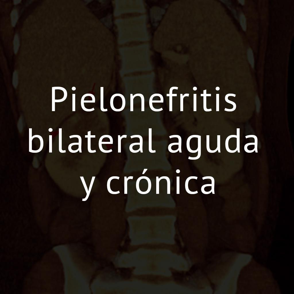 Pielonefritis bilateral aguda y crónica